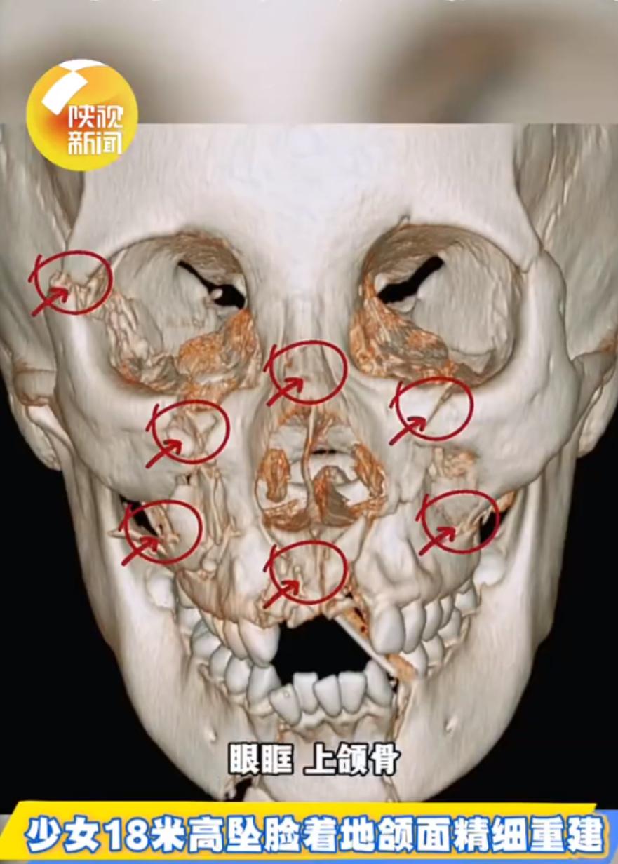巧匠18块钛板78枚钛钉修复少女颌面，西安国际医学中心完成了一例高难度颌面修复手
