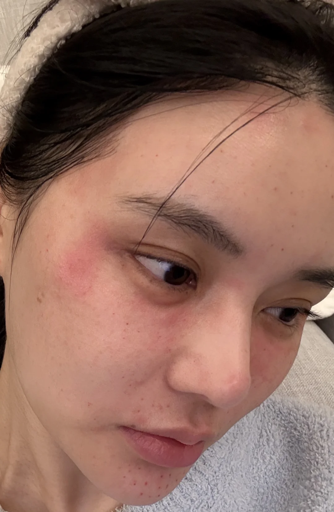 脸上总是这个反复的过敏咋办啊？