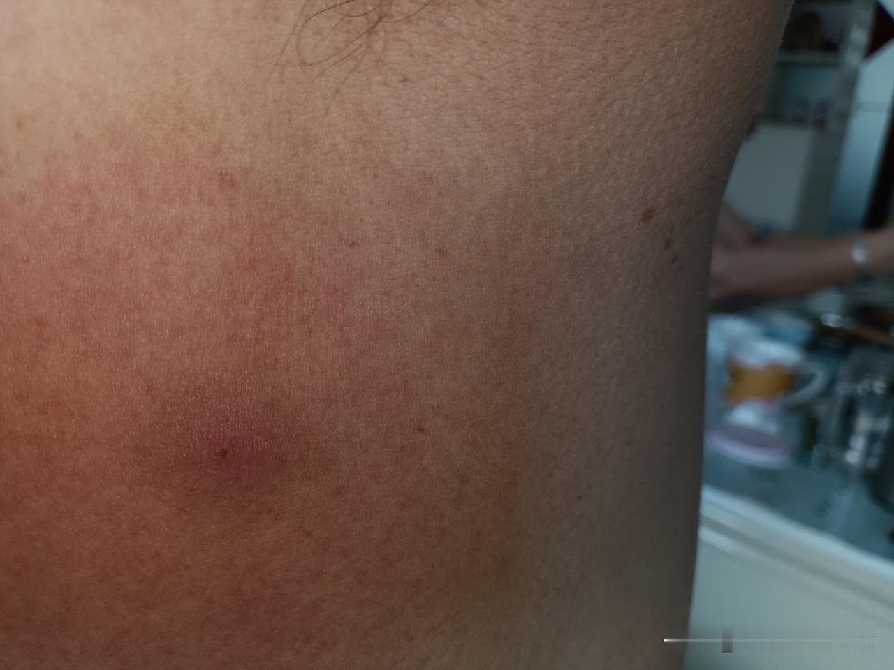 夏天到来 提醒大家一定要注意，我睡了一觉醒来就吃了大亏，家人和亲戚说是带状疱疹多