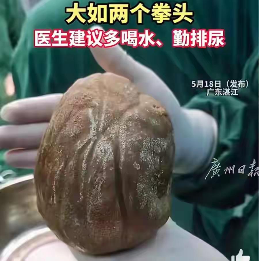 假如人的结石能象竹黄，牛黄一样值钱
这砣2点6斤的巨大人黄起码千万级[捂脸]