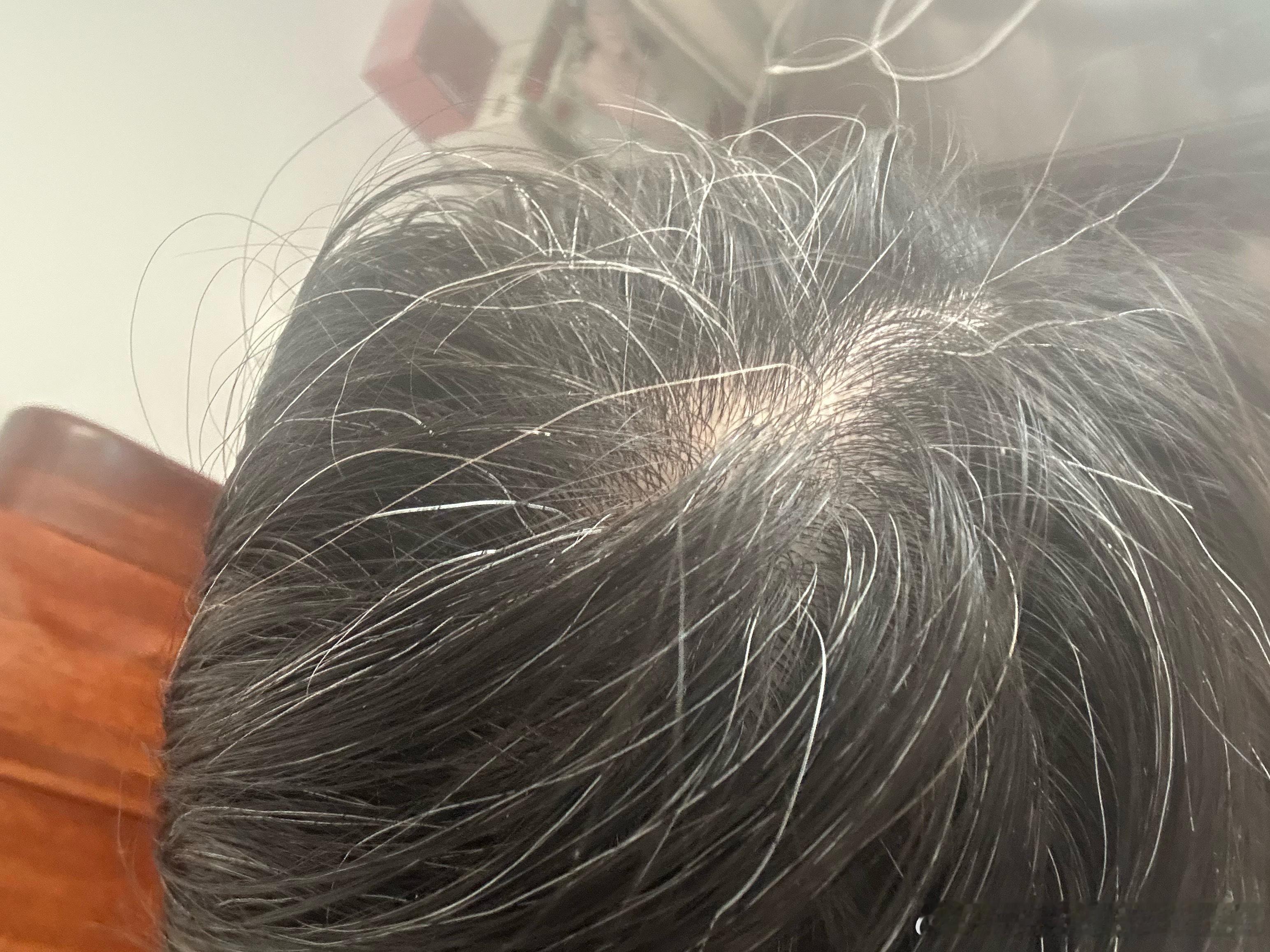 月经弄脏火车卧铺女子发声 给大家展示下被人欺负这三年精神压力过大导致的满头白发