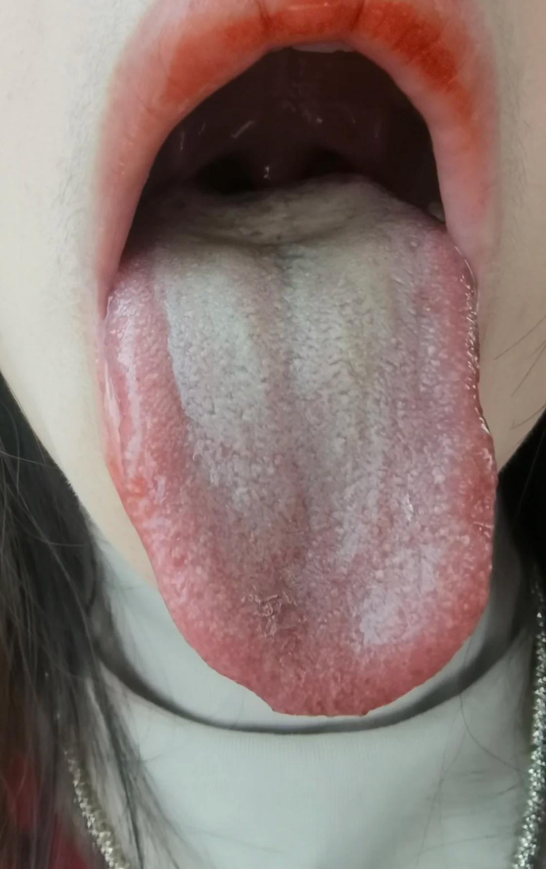 一伸舌头跟“囧”字似的！肝郁的可不轻了
像这种的舌头的人，吃逍遥丸，吃柴胡舒肝丸