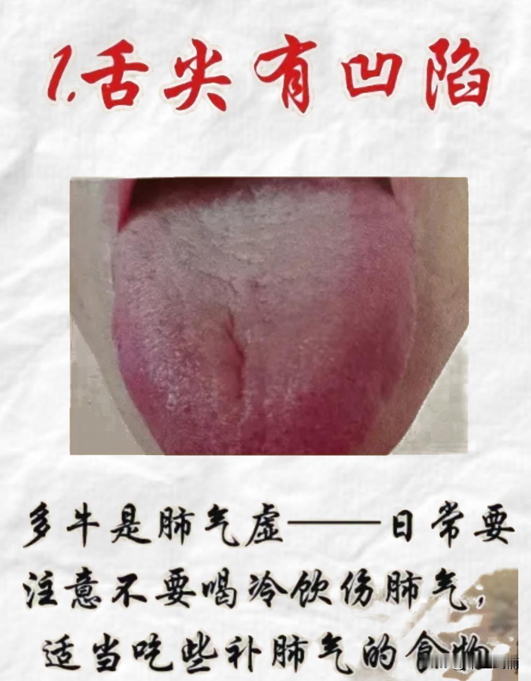 舌象分析中..........
简单教大家几个比较常见的舌象
1.舌尖有凹陷，肺