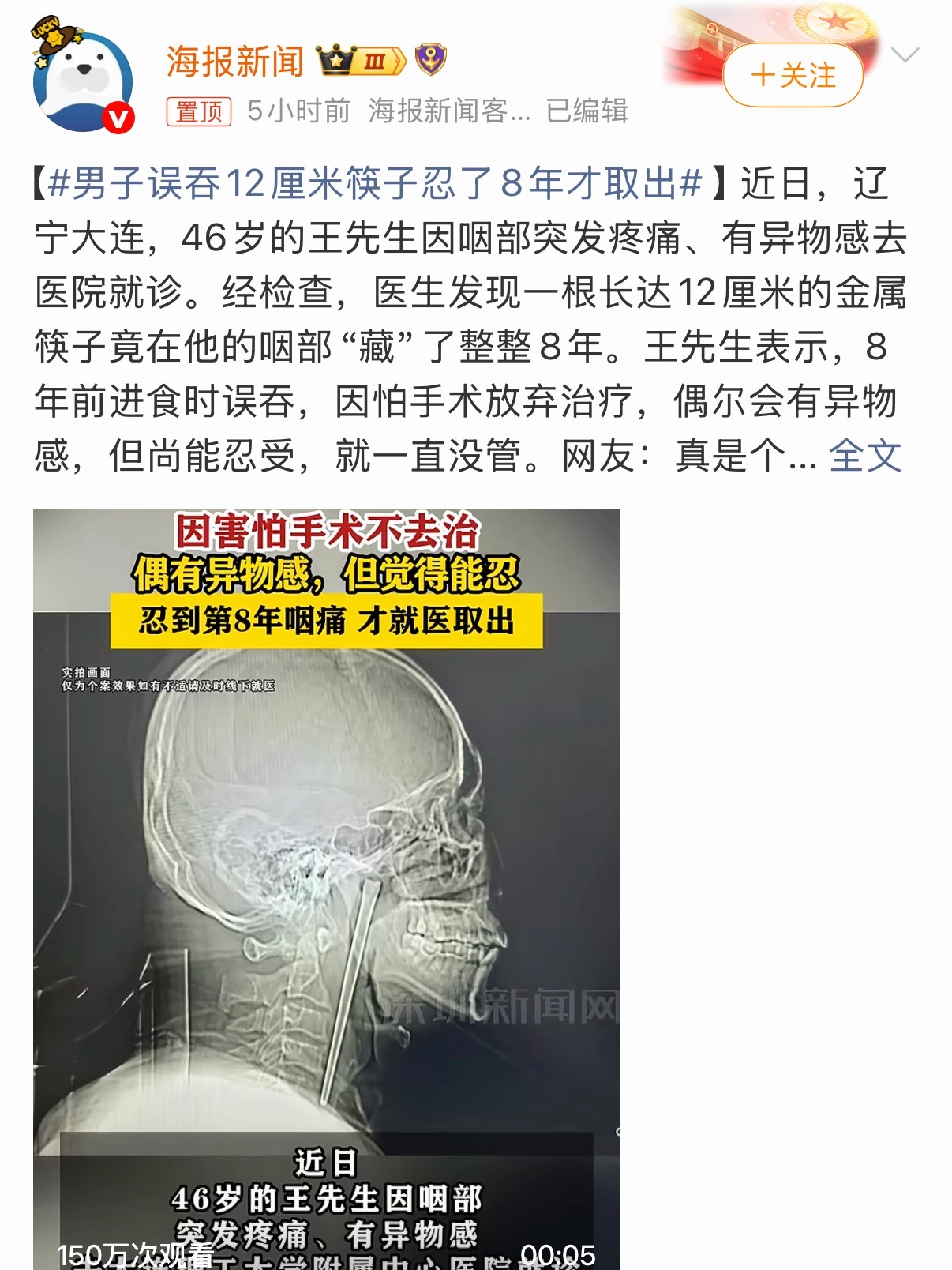 男子误吞12厘米筷子忍了8年才取出幸亏是金属筷子，8年都没有被腐蚀。换成竹的估计