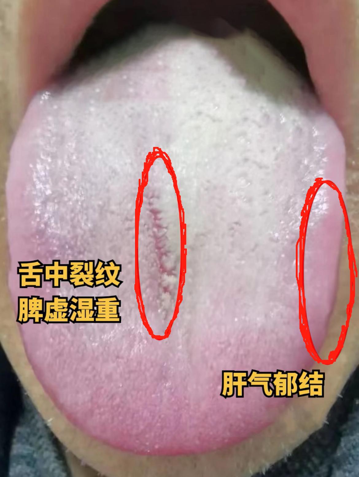 你可别闹了，这舌头你不管，还指望自愈？
舌头辨证为：肾阳虚，脾虚湿重，郁久化热
