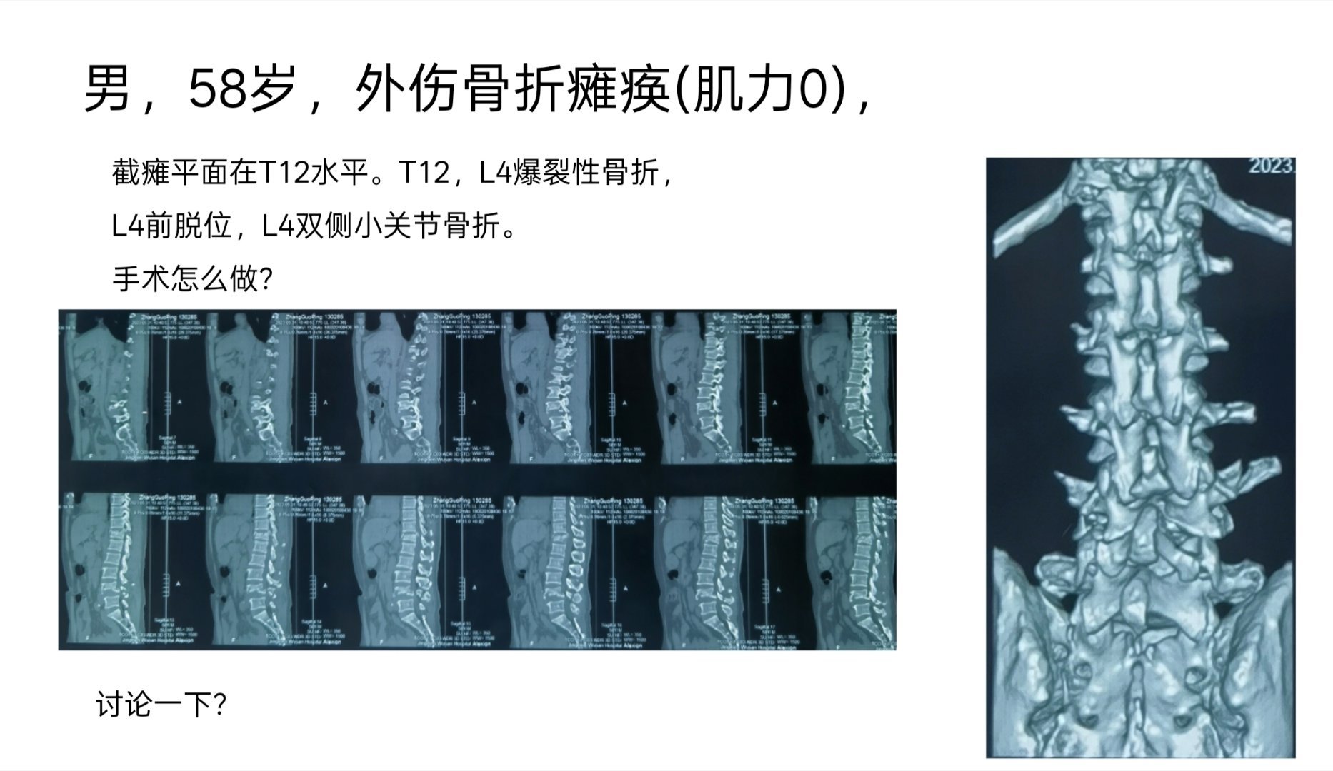 伤后两年半，历经三次手术，全瘫、内固定失败、巨大骨缺损、感染、巨大褥疮的病人站起