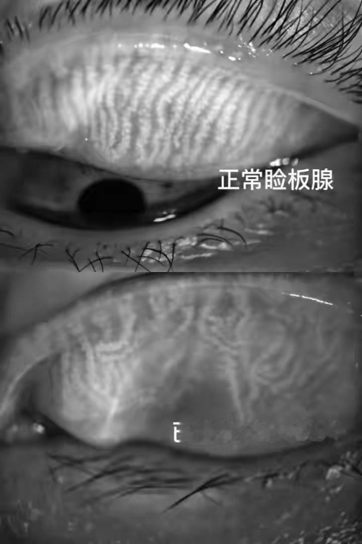 长期待空调房刷手机，女子眼内布满红血丝，损伤不可逆

近日杭州一位女士就诊，长时