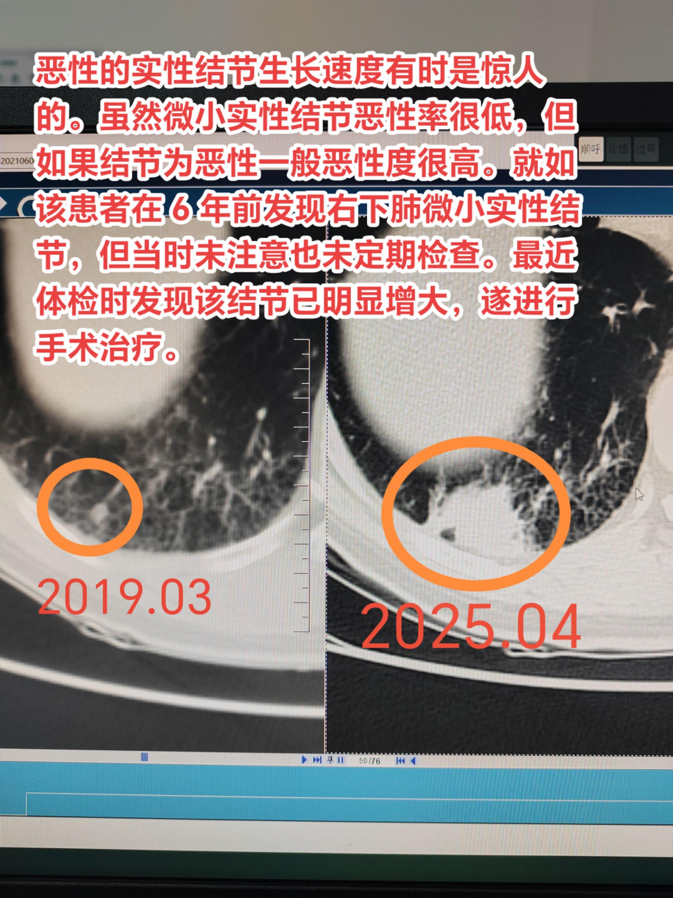 实性结节如为恶性一般生长速度很快！恶性的实性结节生长速度有时是惊人的。...