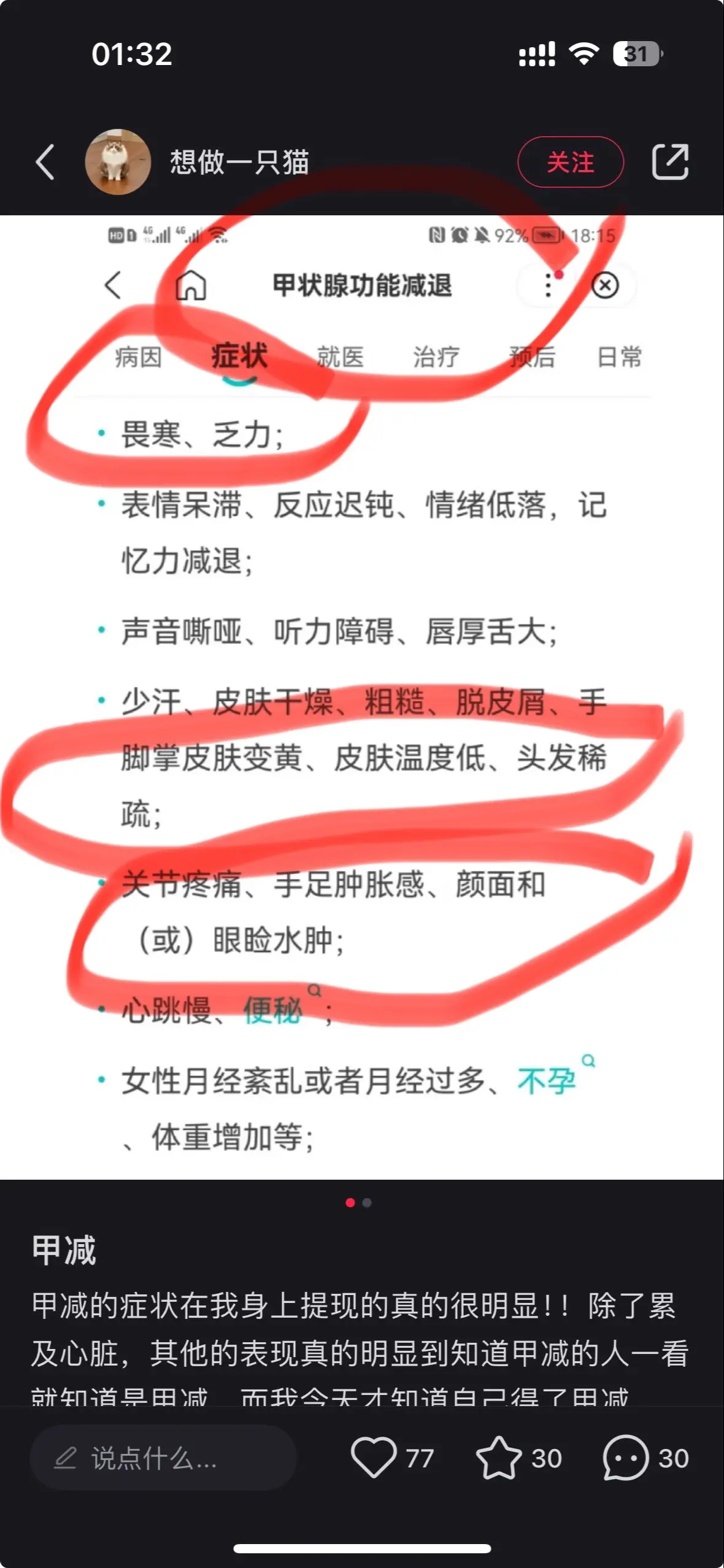 家人们 我不是忽胖忽瘦 我是甲减。去年六月确认甲状腺功能减退 所以经常疲劳 掉发严重 而且不知道哪天就会突然很肿 这就是为什么一个时间段里的我看起来又胖有瘦的 早上还是小蛮腰马甲线 中午可能就小肚腩 走秀的时候还是大长腿 下班可能又看起来粗两倍。 有时候不能控制的低落和突如其来的佛系也是缺乏肾上腺素。 日常生活影响不大 我不是懒人 但是我是个普通人 也会有不完美哦