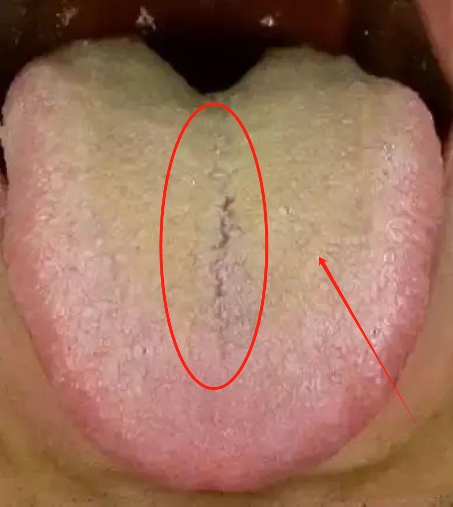 99%的人第一反应都是——湿热！大错特错！盲目清热，后果可能很严重！

表现：整
