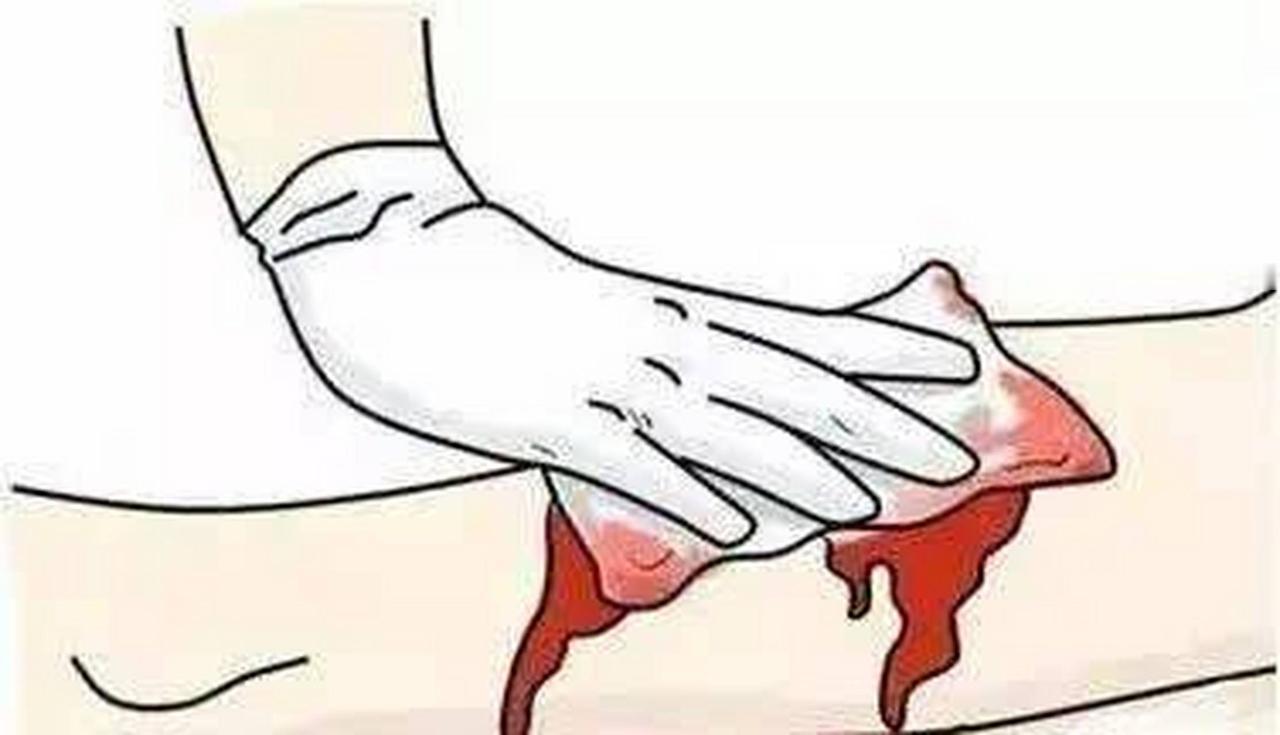 伤口一直流血是怎么回事

伤口一直流血可能是由于血管破裂或凝血功能异常等原因导致