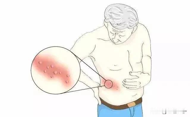 疱疹病毒：一旦感染终身携带，发作时痛不欲生，超9成人体内潜伏有这种病毒

在现代