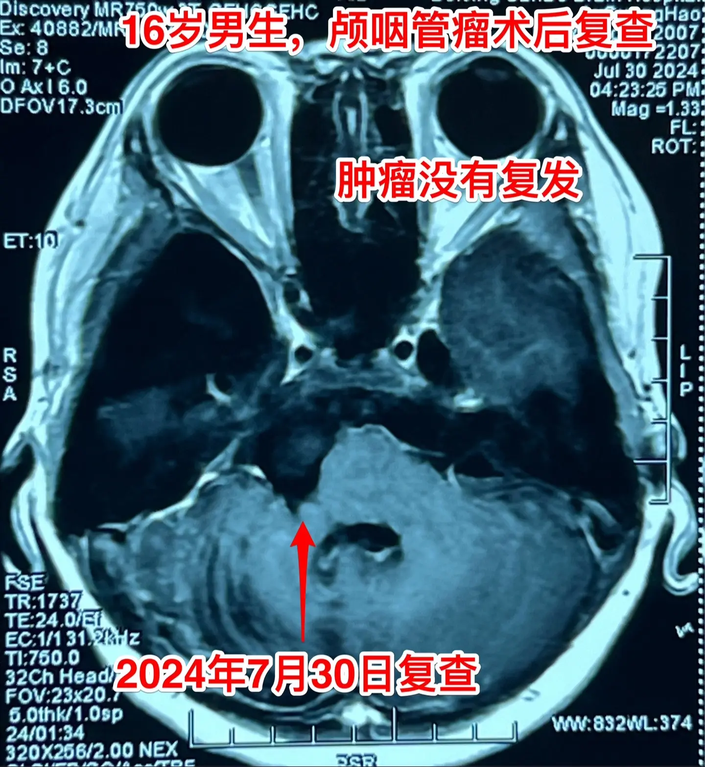 颅咽管瘤复发导致听力下降眼睑下垂。2024年7月30日 16岁男孩子颅...