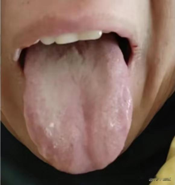 阳虚阴虚傻傻分不清？这种舌象可不是单单的脾虚
今天来了一位患者，说自己脾虚，在家