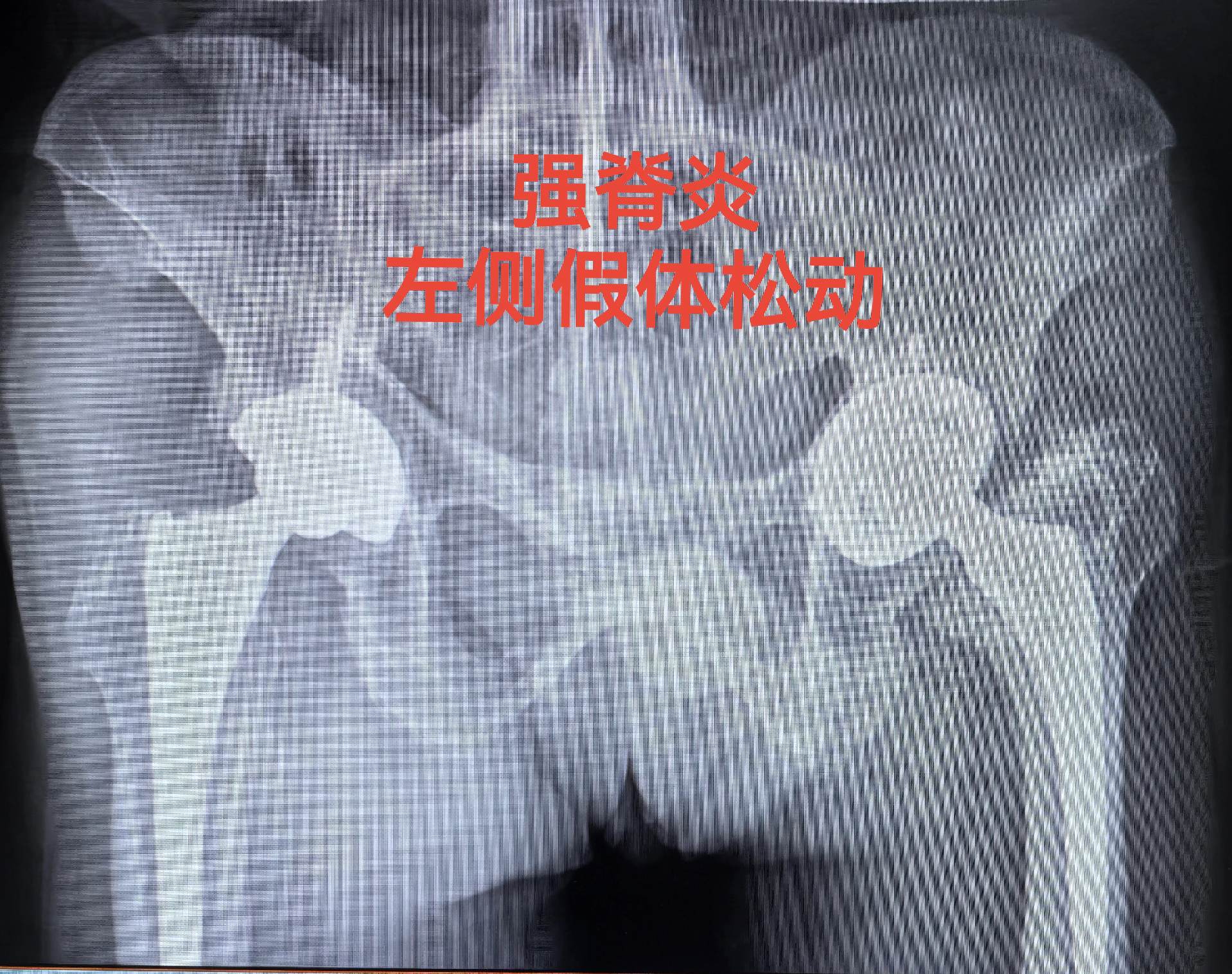 髋关节翻修。强脊炎THA后假体松动，术前短3cm，术后等长。难点：松动...