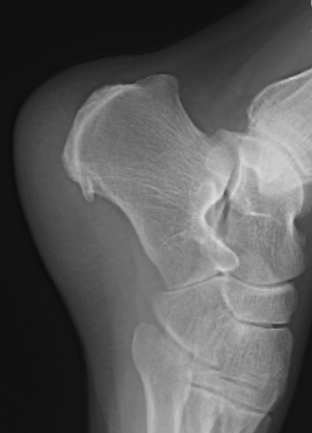 脚后跟骨刺形成，疼痛四个多月，用过好多膏药，吃过好多跌打丸，各种办法换着用，还就