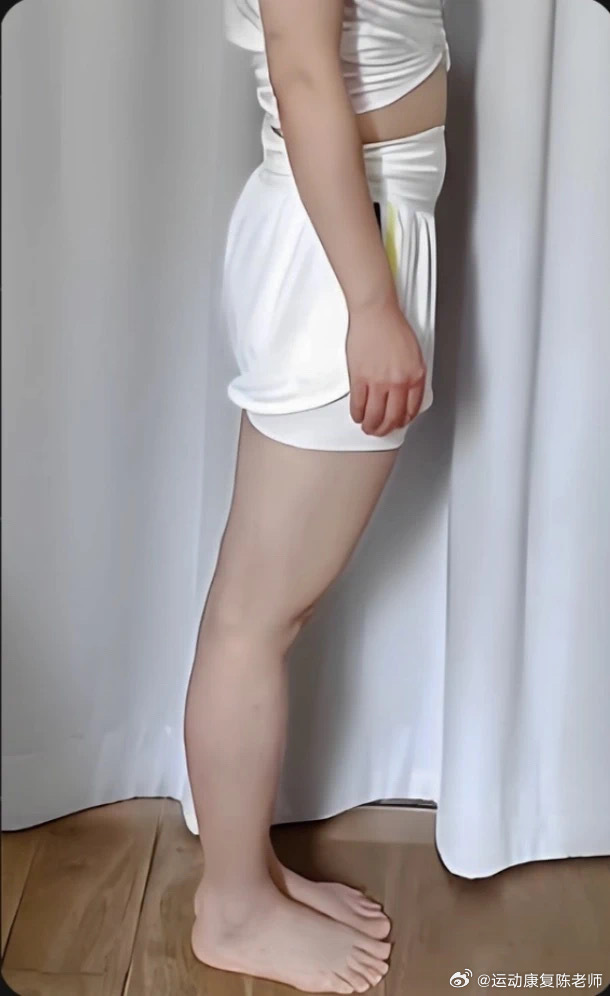 膝超伸 大家在日常生活中有没有见过图1的站姿，侧面看腿粗，小腿容易粗？这也是我们