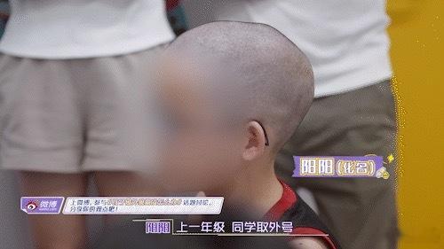 #孩子被外貌霸凌怎么办# 看到#闪闪的儿科医生# 里13岁的阳阳因为颅缝早闭导致