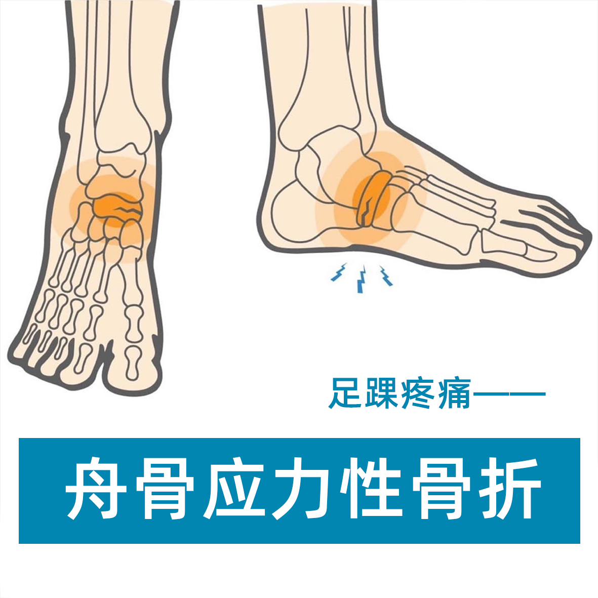 脚踝疼痛康复 今天来讲讲我们的脚踝前侧/内侧疼痛损伤——应力性舟骨骨折，它是怎么