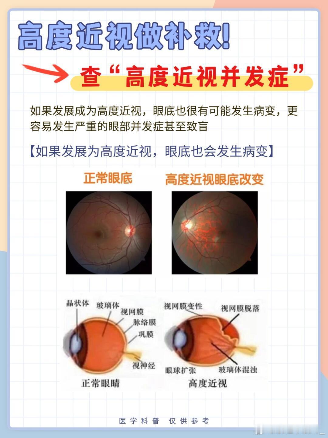 近视焦虑眼科医生划重点：四查轻松做好孩子近视防控 🔍 第一查：视力筛查表👉 