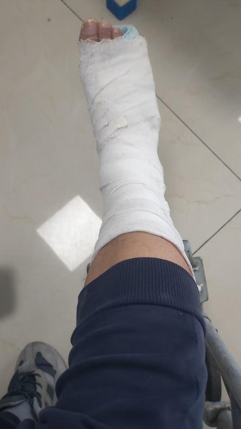 终于拆了，一个月了，小小骨折境限制我自由！伤筋动骨一百天，让它自然慢慢恢复吧