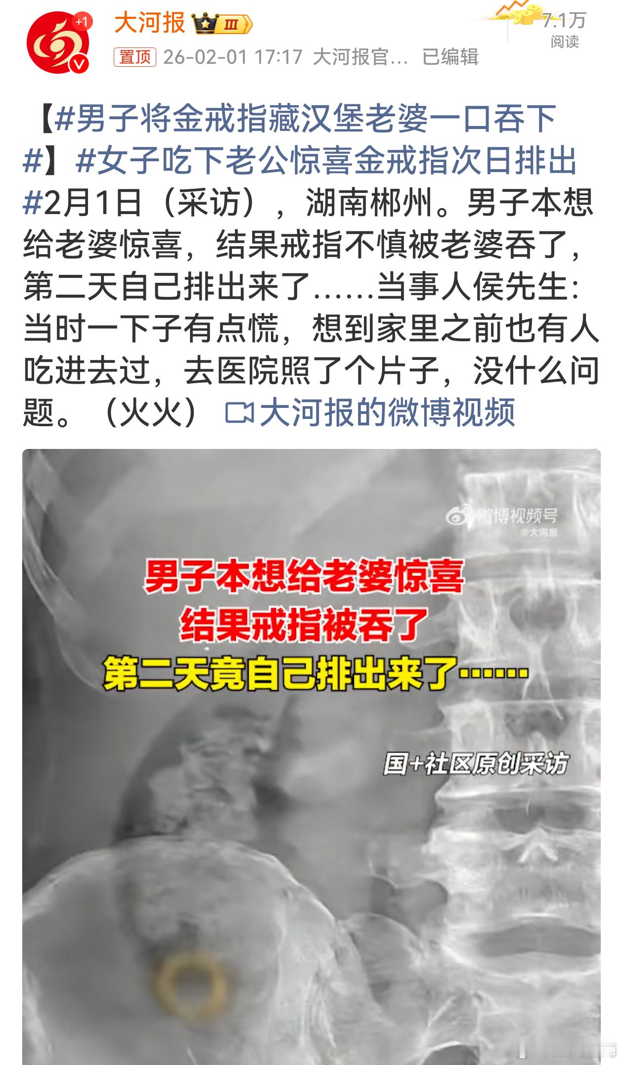 男子将金戒指藏汉堡老婆一口吞下侯先生惊喜藏环，老婆一口“吞欢”。医院检查心安，戒
