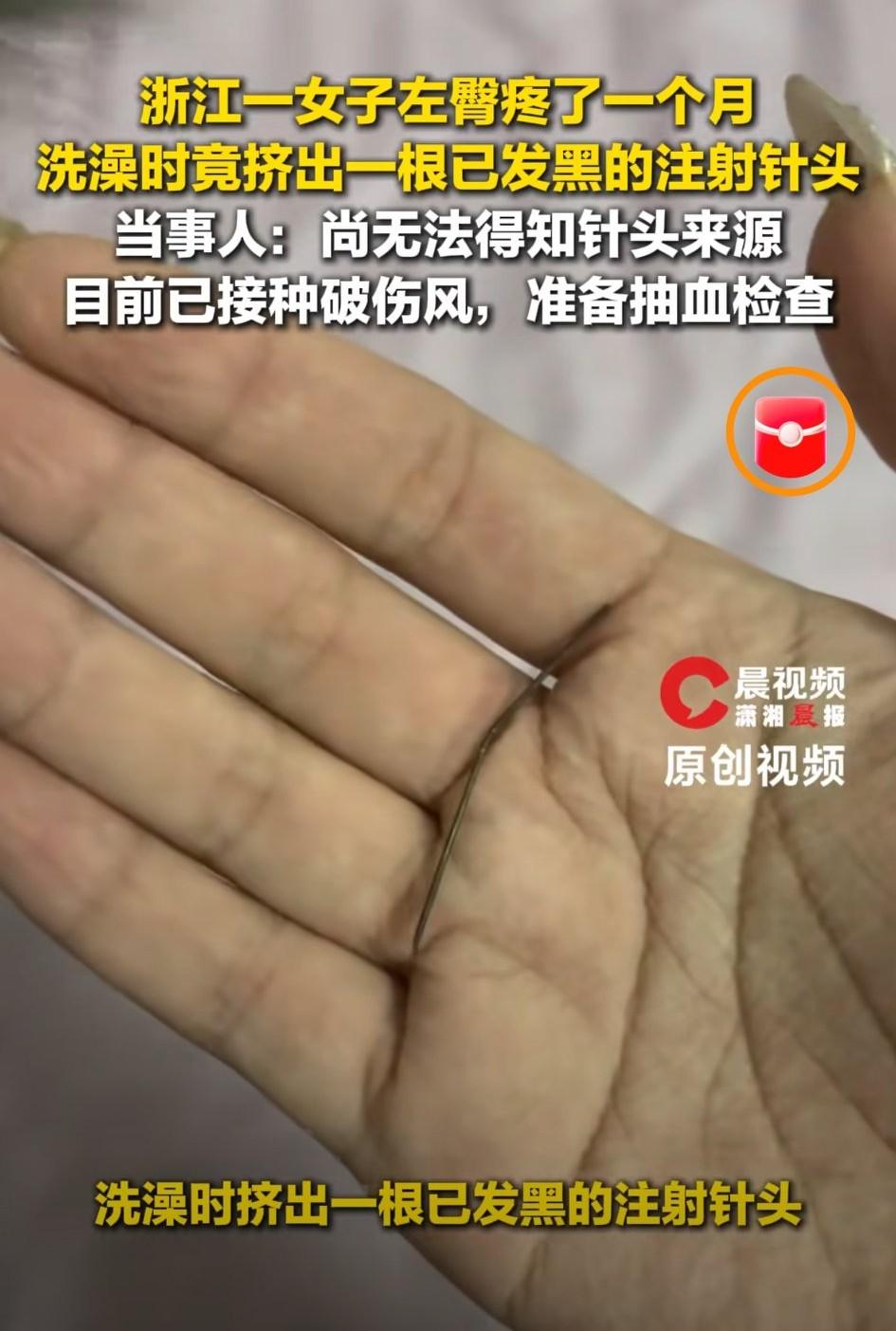 万万没有想到，浙江，一女子左臀持续疼痛一个月，起初女子以为是自己近期运动锻炼导致