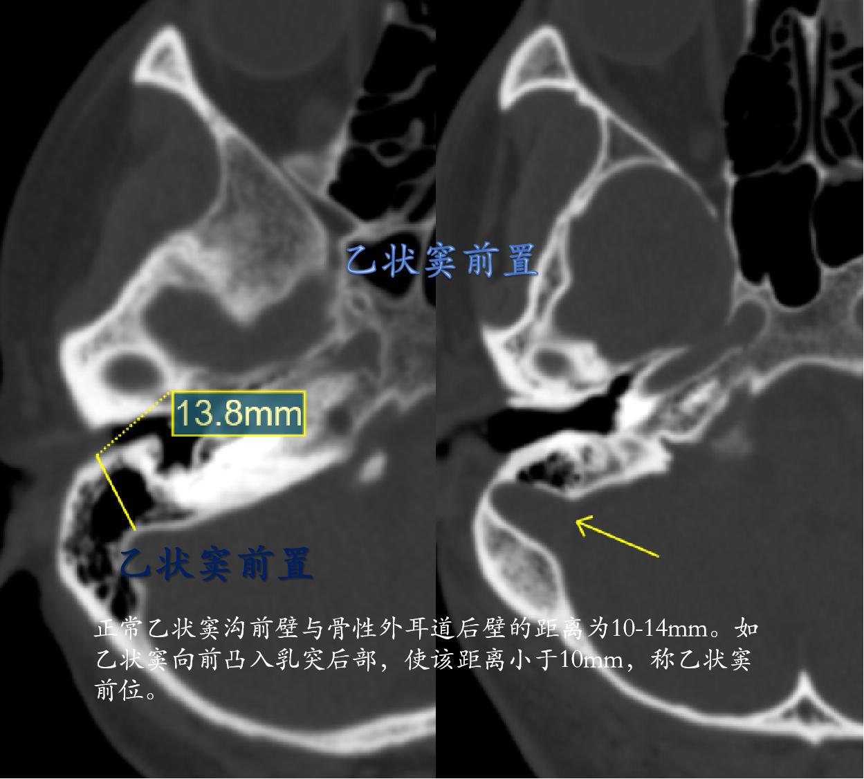 乙状窦前置是一种解剖位置的变异，表现为乙状窦板与外耳道后骨壁紧贴或者融...