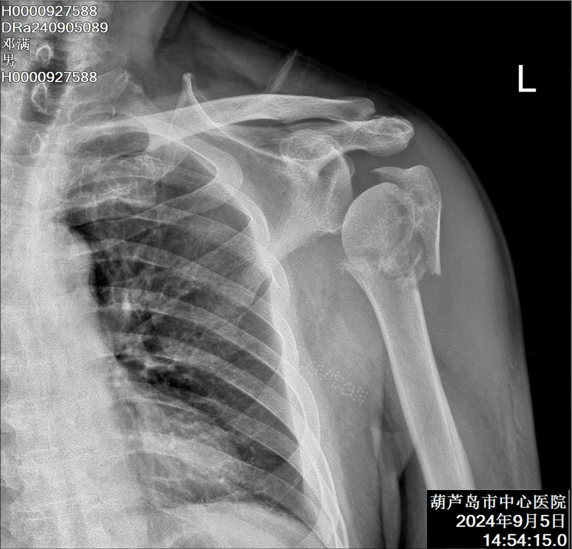典型的肱骨近端三部分骨折，患者不同意髓内结构性植骨，多打螺钉吧，还算结...