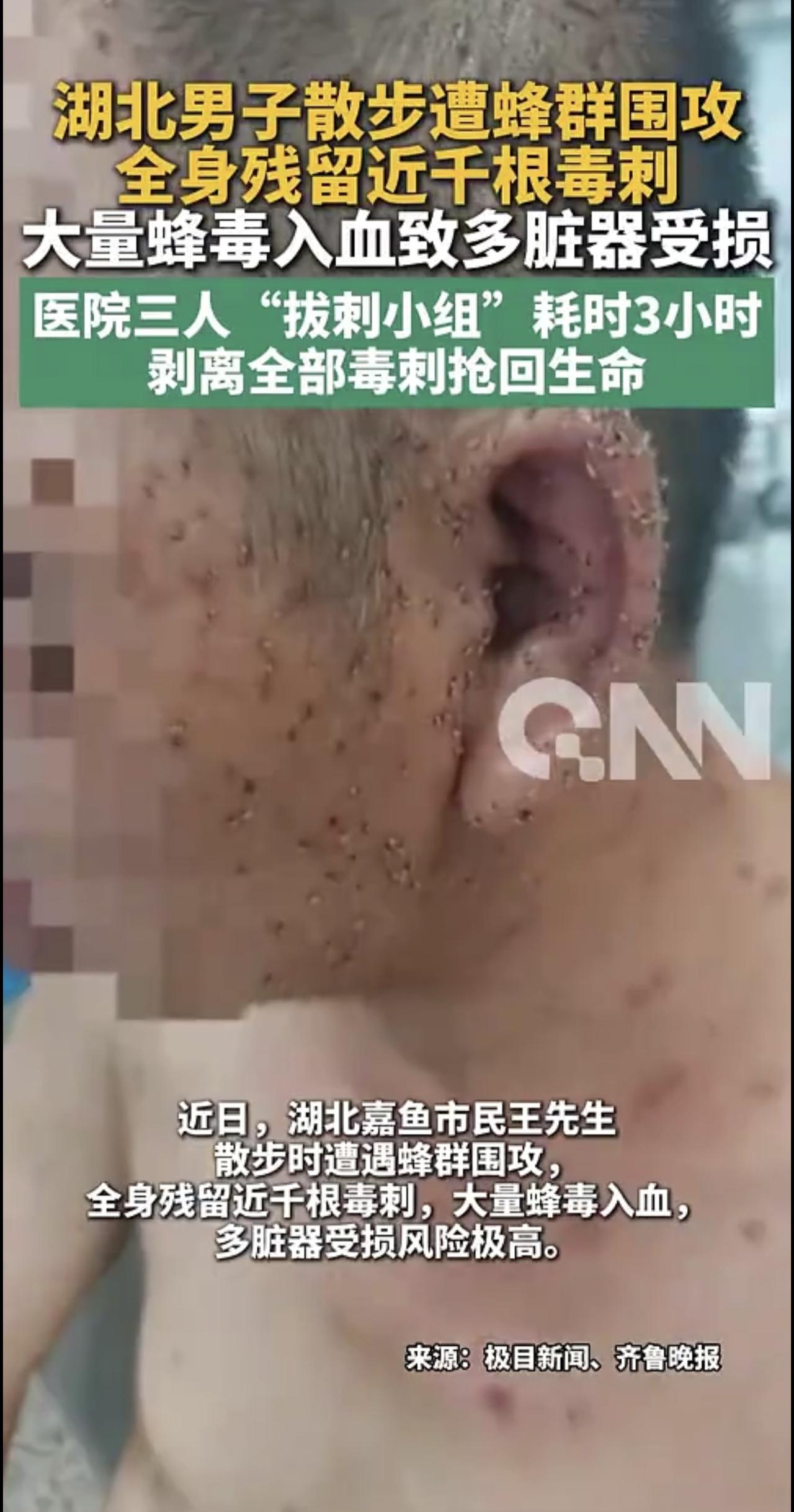 男子散步遭蜂群围攻，全身残留近千根毒刺，大量蜂毒入血致多脏器受损；医院三人“拔刺