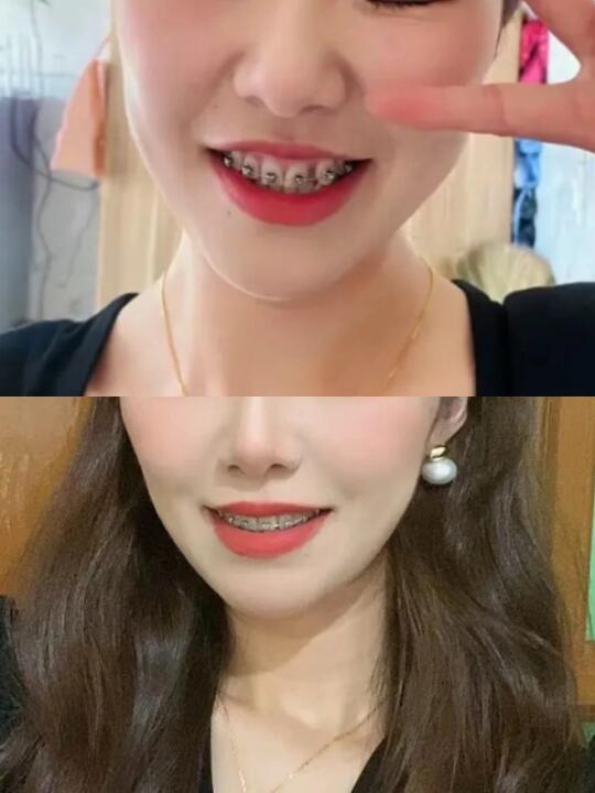 义乌正畸我推荐这个审美技术都在线的医生！