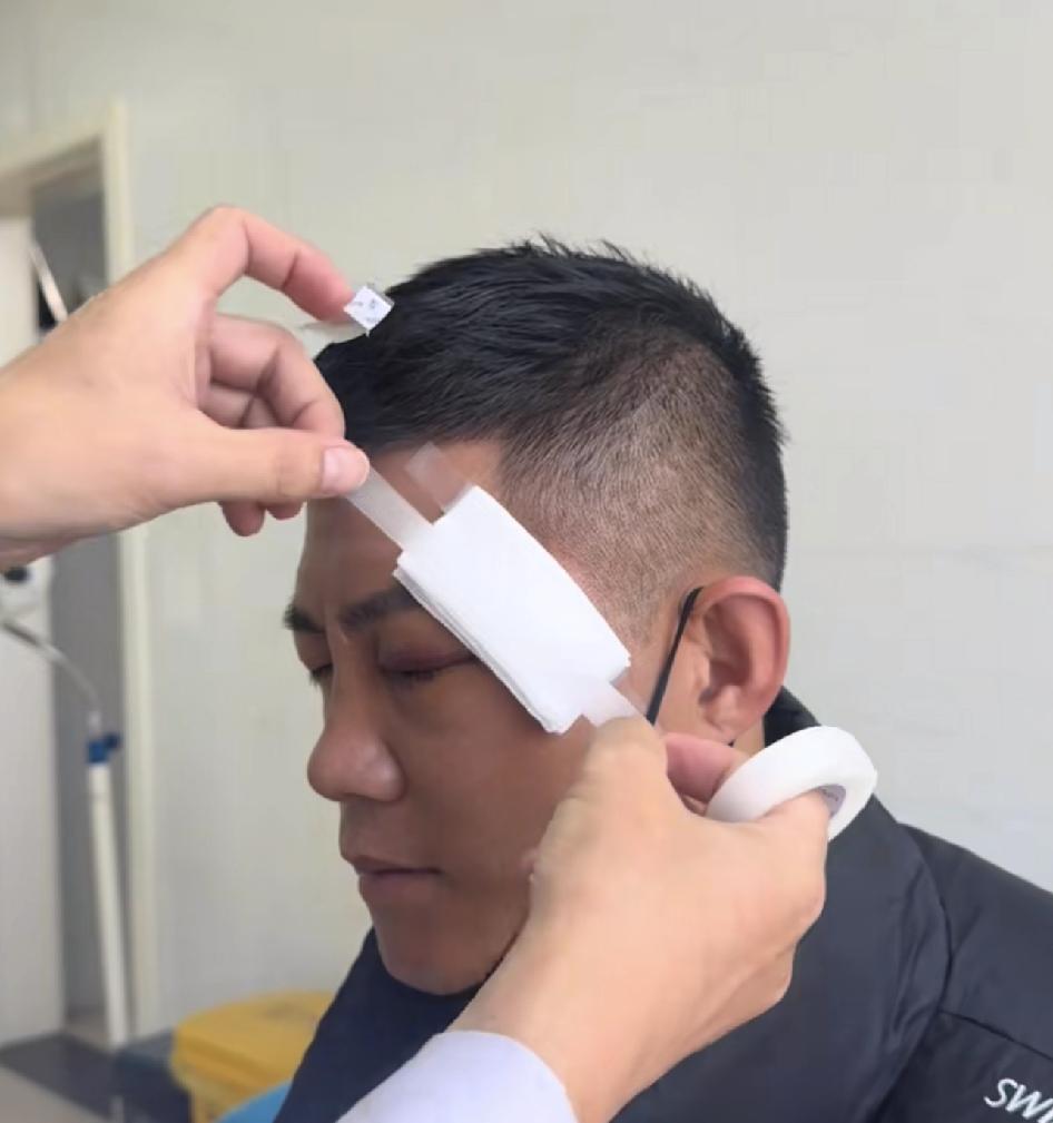 国内医院的诊断，赵鸿刚下眼眶骨折。

没看过视频就少说风凉话，我再不懂也知道国外