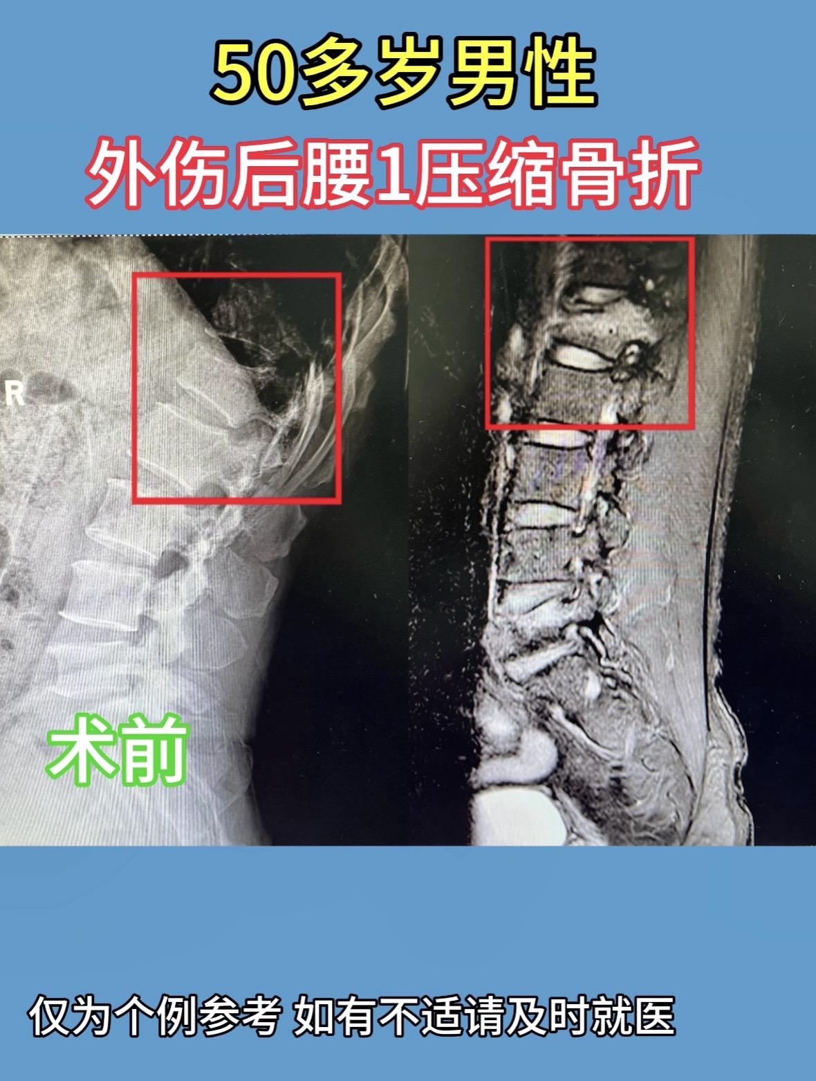 50多岁男性，1周前外伤后腰1压缩骨折，术中通过钉棒撑开高度即刻恢复...