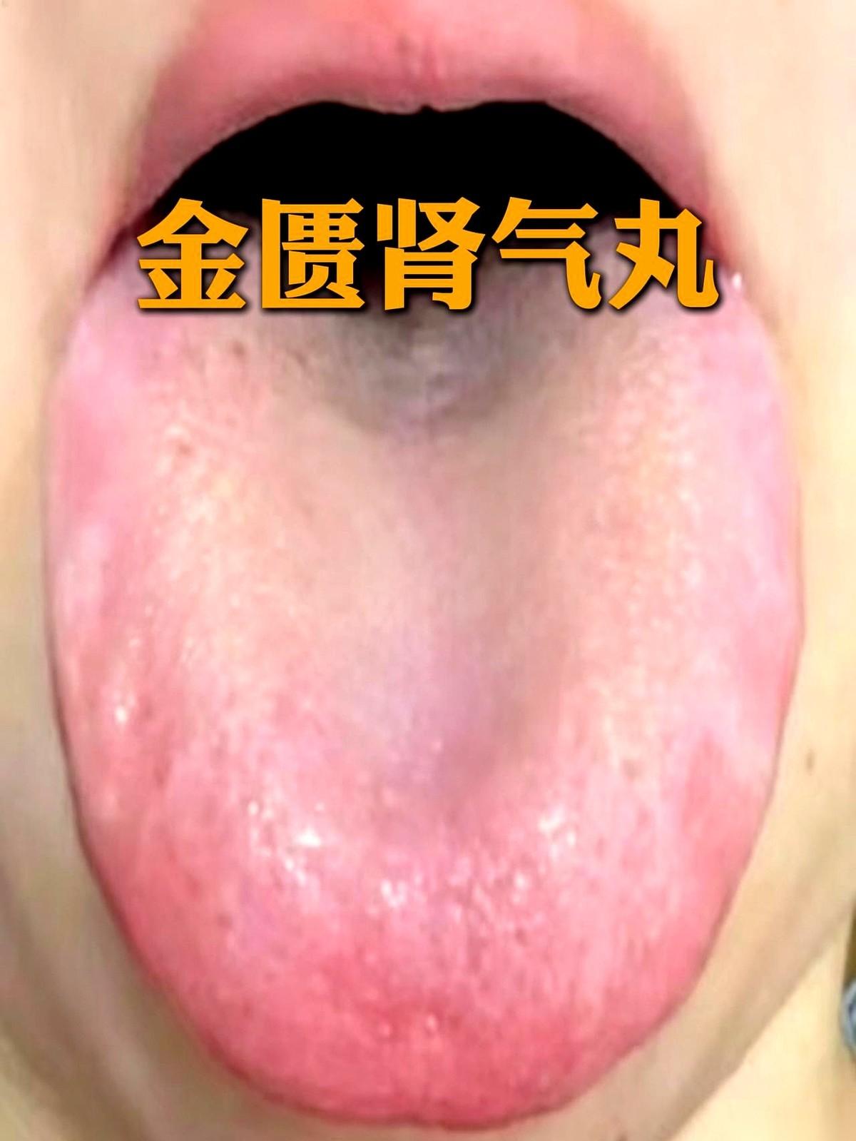 很多人那瓶六味、右归丸，是真吃反了。
一把药吞下去，越吃火越大，或者越吃人越哆嗦