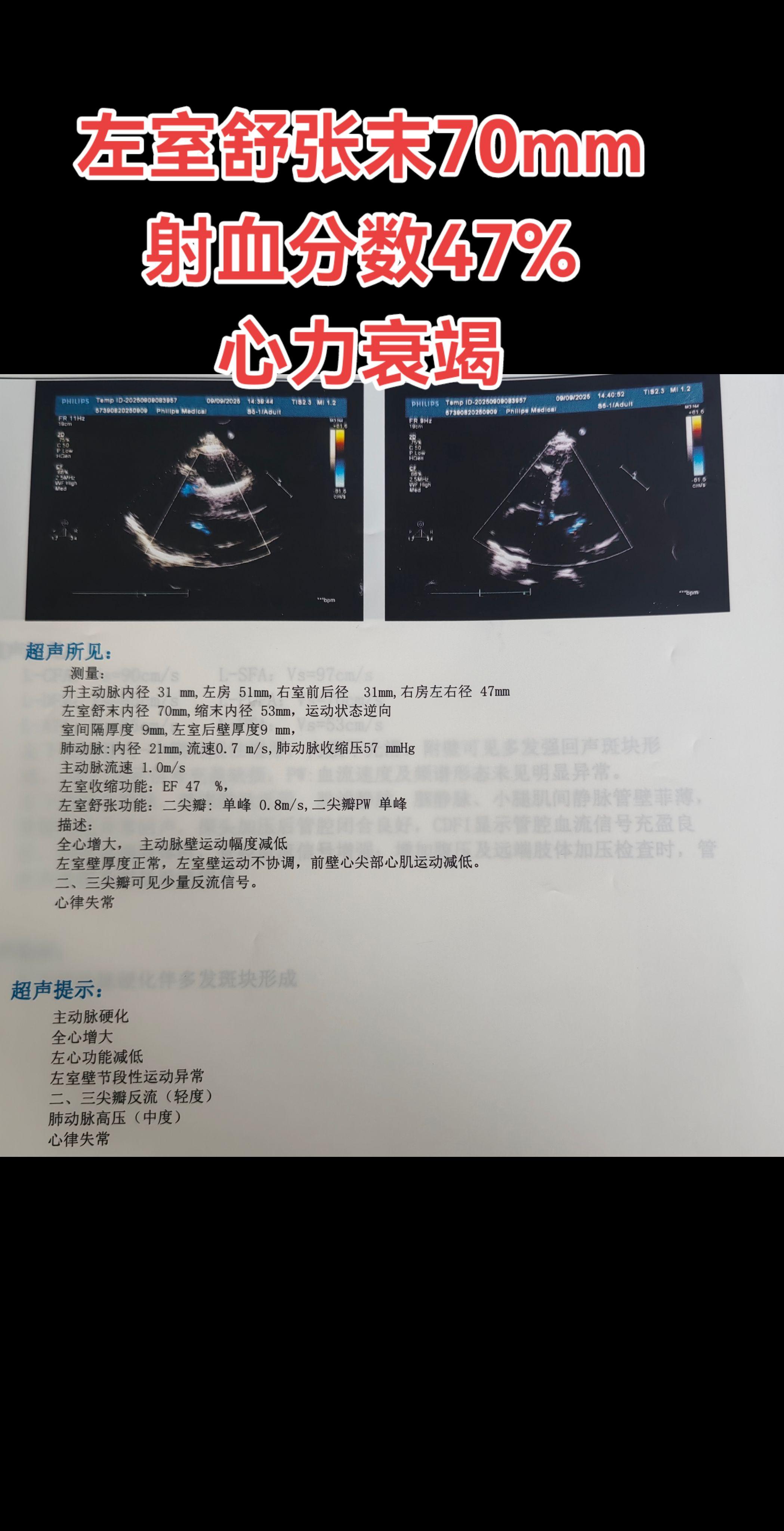 心力衰竭。 患者有全心衰表现，活动后喘息伴下肢水肿，需要应用药物调理一下。