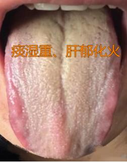 这样的舌头，湿热可不是一天两天了，不及时调理，身体只会更虚！
 
患者情况：宗筋