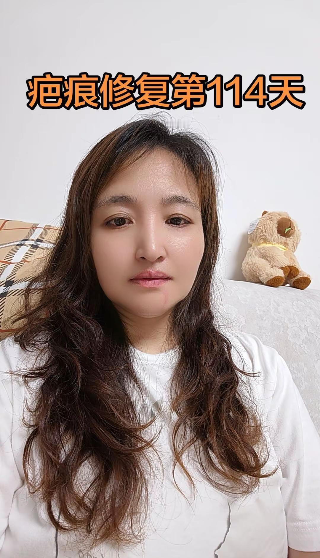 一场意外，双手历经磨难，慢慢结痂新生。难熬的日子总会过去，静待痊愈，往后平安顺遂