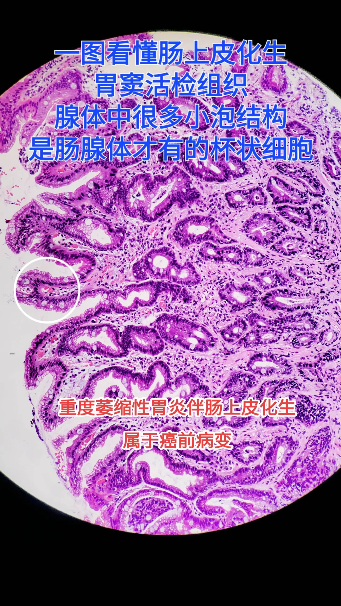 肠上皮化生