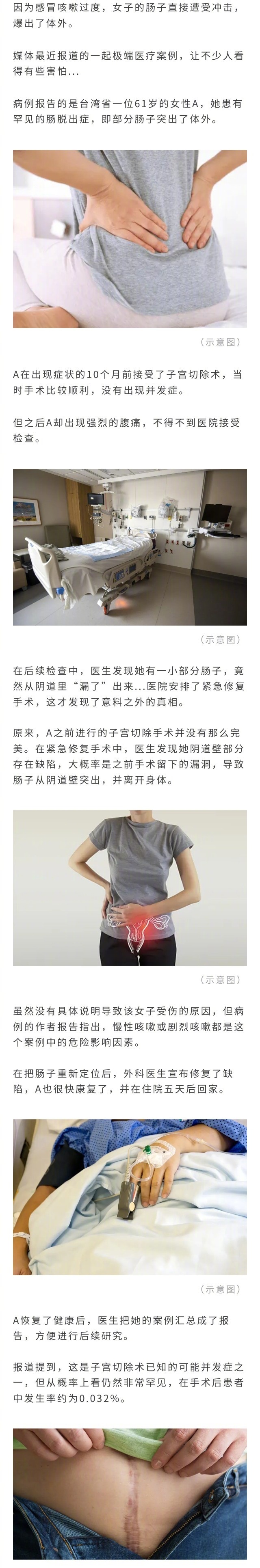 女子咳嗽后肠子从下体喷出，因之前做过妇科手术...？？ ​​​