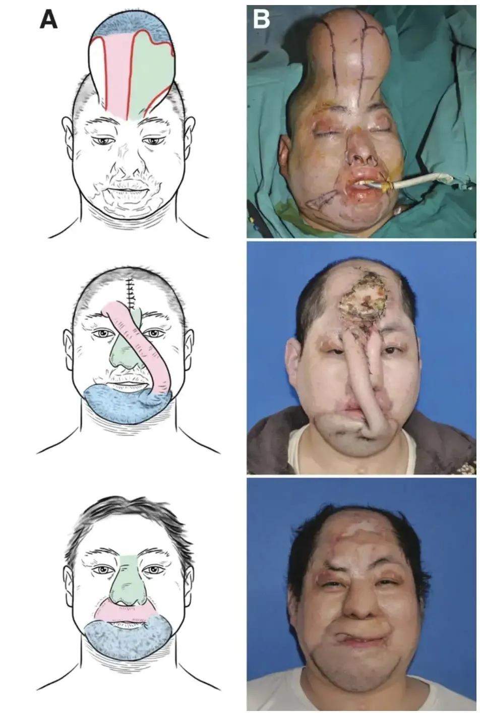 好吓人！[发怒]
别怕，这是治病！

大哥鼻子、口唇、下颌皮肤被毁，需要植皮，可