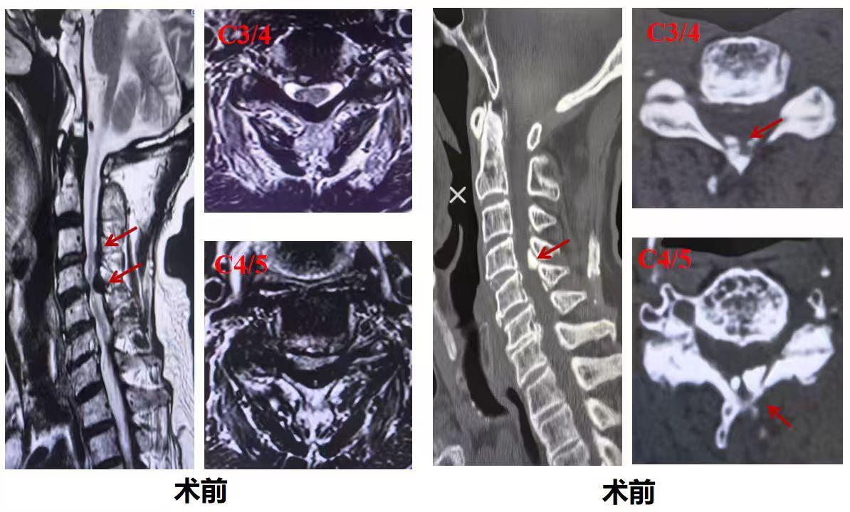 病例分享：一位86岁高龄患者，存在肢体麻痛、行走不稳症状。MRI显示脊髓严重受压