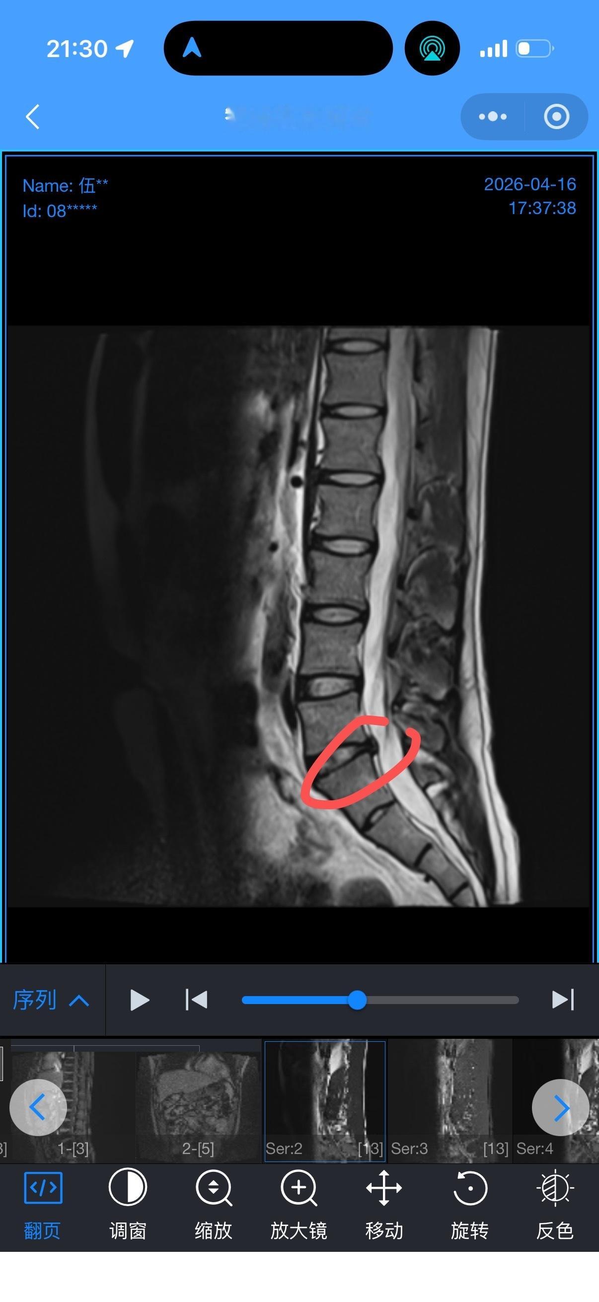 我这也应该是腰突了吧