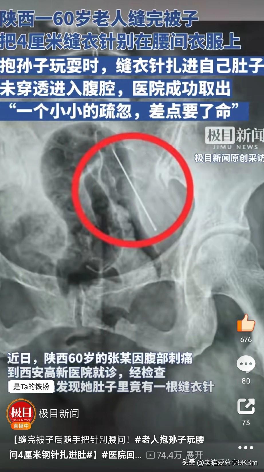 千万不要把针别在自己的衣服上

陕西西安一位60岁的大妈，平时爱缝缝补补。前几天