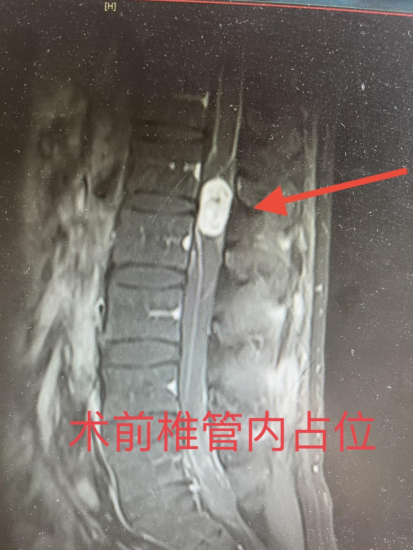 上次分享31岁男性椎管内占位患者已行手术治疗。分享术后复查磁共振，肿物摘除干净。