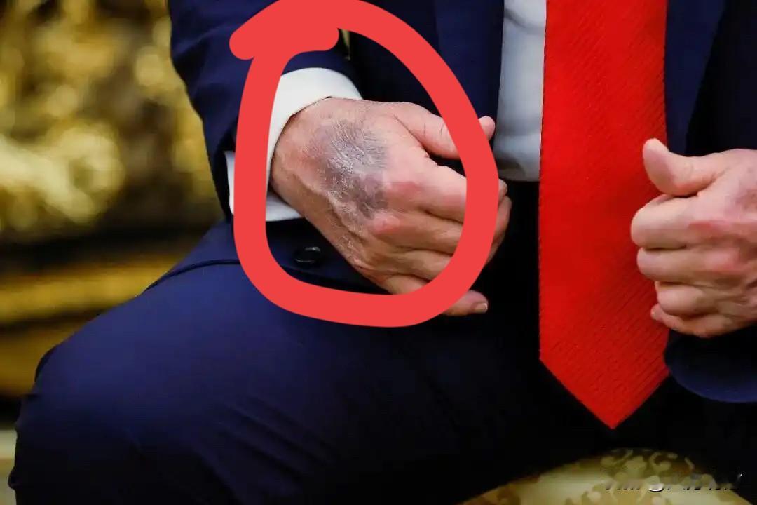 看懂王那份作息表，
看看他的折腾劲儿，
手上有青筋算啥呀？

快八十岁的人了，不