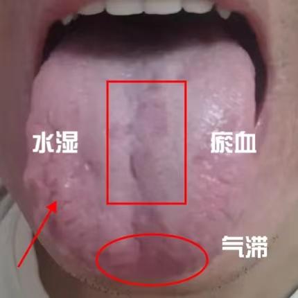 又是一个脾阳虚的舌象！有水湿不说，还有瘀血了！心肺功能差，还有阳事不兴等问题，千
