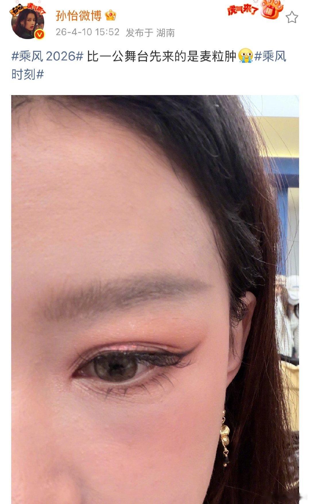 孙怡说比一公舞台先来的是麦粒肿孙怡眼睛长了麦粒肿孙怡说比一公舞台先来的是麦粒肿，