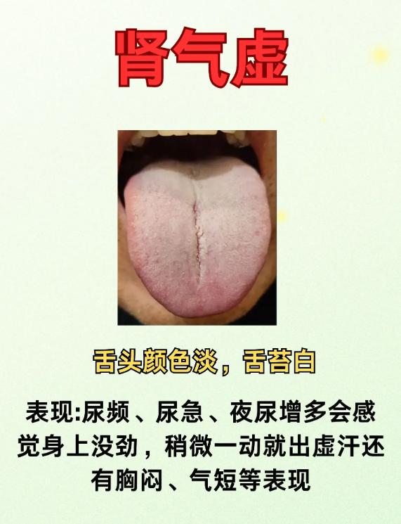别再乱补肾！3 种肾虚舌象，一次分清