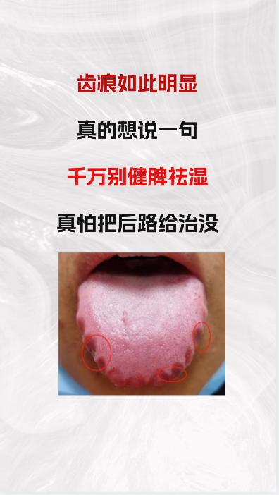 看这个舌象，如此多且明显的齿痕，我真心的劝你，千万不要健脾祛湿，真怕你切断自己的