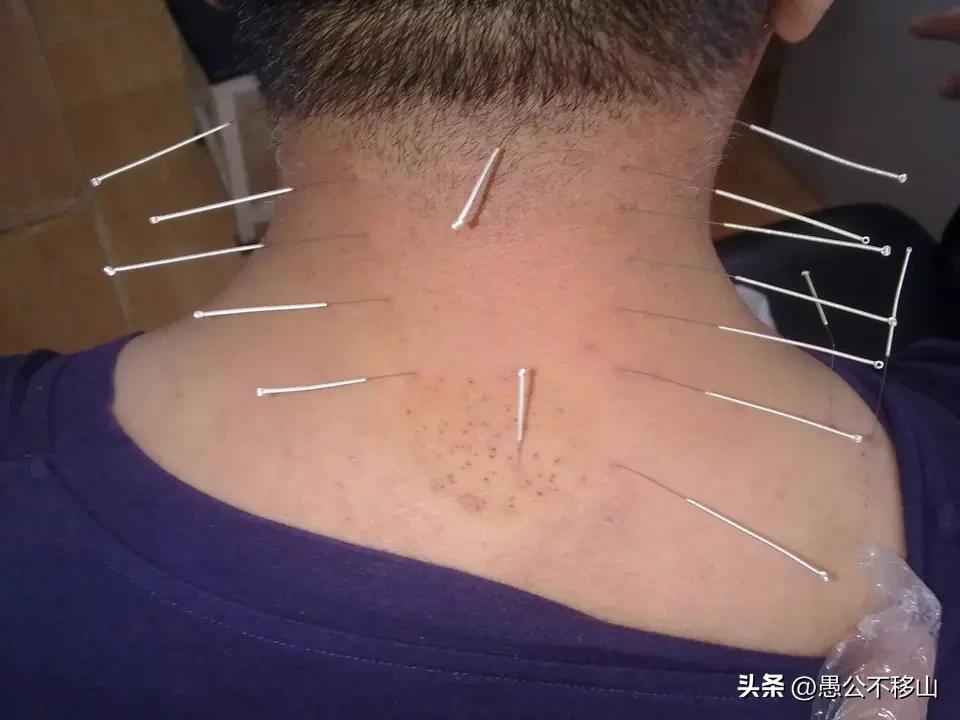 经络穴位与中西医的关系

       西医对人体经络还没有认知，认为不存在人体